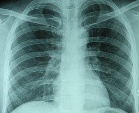 胸透、X光 (图片：Wikimedia)