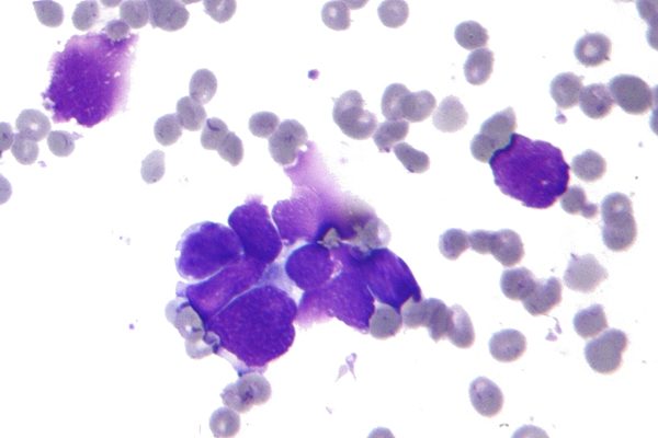 镜下癌细胞（图片来源：维基百科）