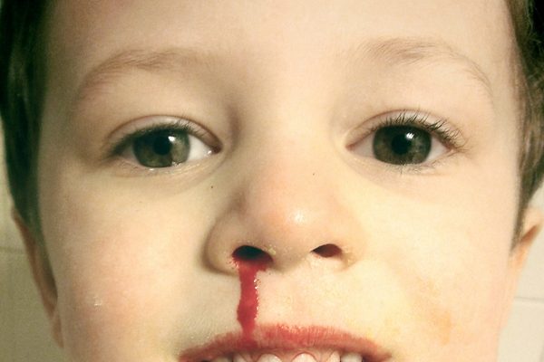 流鼻血（图片来源：维基百科）