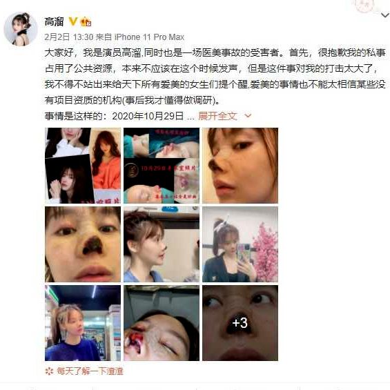 大陆女星整形失败 鼻头发黑坏死 惨不忍睹 高溜 高溜整形失败 高溜鼻子 希望之声