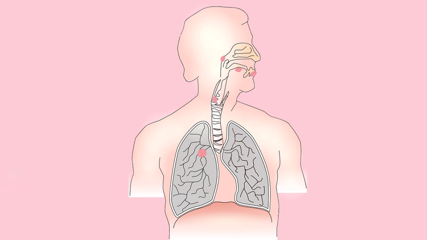 several-symptoms-of-throat-cancer-throat-cancer-hoarseness-pain