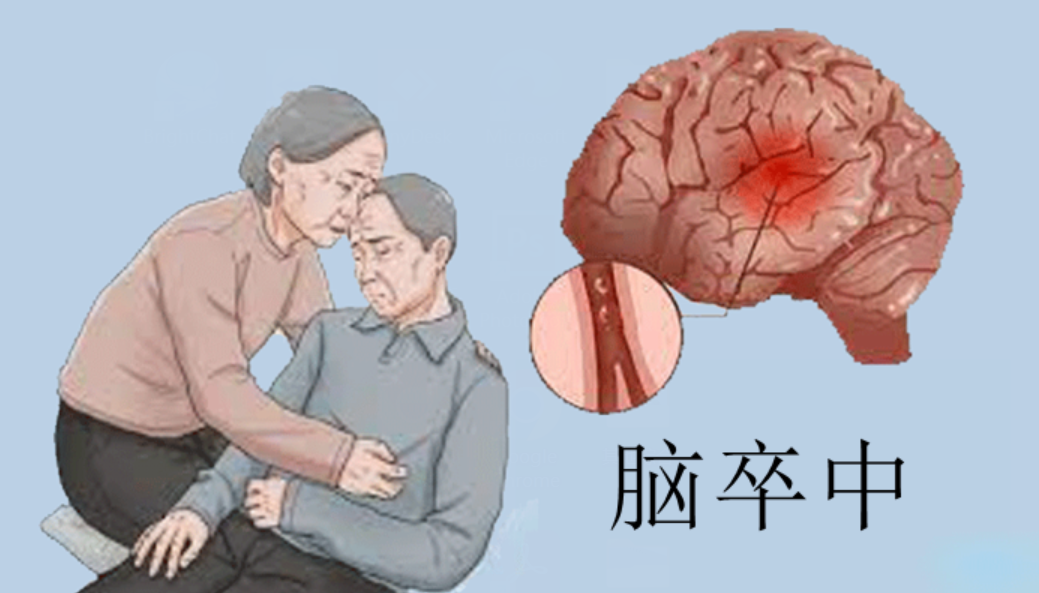 The Rise of Stroke Among Young People: Causes, Warning Signs, and Treatment Options