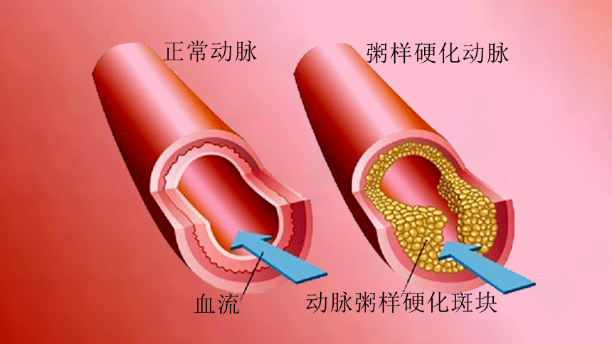 Study Reveals High Cardiovascular Risk in Patients with Subclinical Atherosclerosis