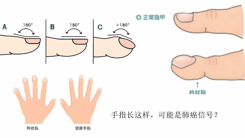 The Hidden Clues: How Your Fingers Can Indicate Serious Diseases